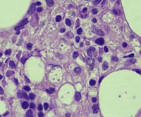 Bone marrow histoplasmosis. BMBXX100