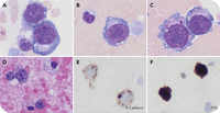 Immature erythroblasts in pleural effusion: an initial presentation of acute erythroid leukemia in a patient with a history of MDS