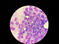 PLASMA CELL LEUKEMIA 1