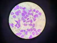 PLASMA CELL LEUKEMIA 2