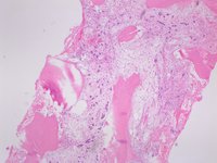 Invasive Ductal Carcinoma in Bone Marrow 1