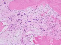 Invasive Ductal Carcinoma in Bone Marrow 2