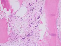 Invasive Ductal Carcinoma in Bone Marrow 3