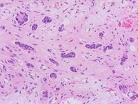 Invasive Ductal Carcinoma in Bone Marrow 4