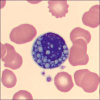 Mott cell in peripheral blood associated with Covid-19 infection