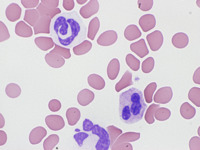 Dysgranulopoiesis 1