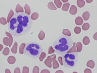 Dysgranulopoiesis 2