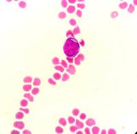 Myeloblast in Peripheral Blood Smear