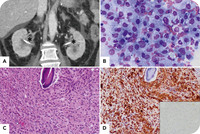 Erdheim-Chester disease in a patient with multiple myeloma