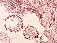 Nasal Aspergillosis (Conidia) in a Post-COVID19 patient with topical steroid overuse