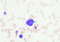 Erythroid dysplasia 1