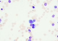 Erythroid dysplasia 2