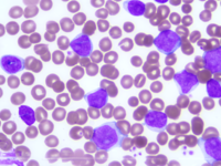 Chronic Lymphocytic Leukemia with trisomy 12 1