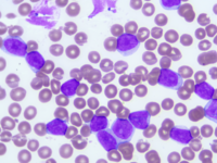 Chronic Lymphocytic Leukemia with trisomy 12 2