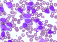 Chronic Lymphocytic Leukemia with trisomy 12 3