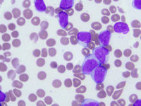 Chronic Lymphocytic Leukemia with trisomy 12 4