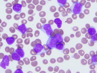 Chronic Lymphocytic Leukemia with trisomy 12 5