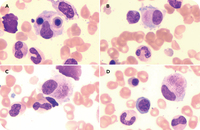 Typhoidal cells: unraveling the diagnostic conundrum in brucellosis instead