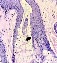 Demodex Folliculorum in scalp biopsy, planned for hair transplantation