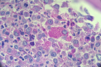 CML with pseudogaucher cells 1