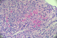 CML with pseudogaucher cells 2