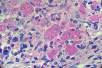 CML with pseudogaucher cells 3