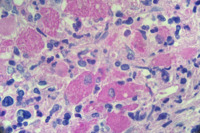 CML with pseudogaucher cells 4
