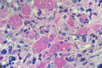 CML with pseudogaucher cells 4