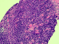 BPDCN and CMML - skin core biopsy