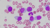 BPDCN and CMML - bone marrow aspirate 1