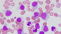 BPDCN and CMML - bone marrow aspirate 2