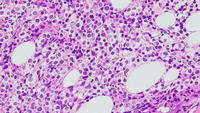 BPDCN and CMML - bone marrow trephine