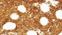 BPDCN and CMML - CD4 immunostain of bone marrow trephine