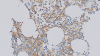 BPDCN and CMML - CD123 immunostain of bone marrow trephine