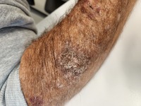 BPDCN and CMML - right forearm after chemotherapy