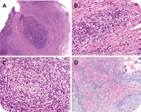 Secondary syphilis: first evidence of diagnosis on a lymph node biopsy