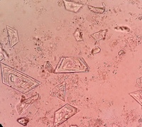 Cholesterol Crystals in Urine Sediment of an adult male