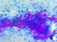 Mucor in lung parenchymal lesion on ROSE of EBUS-TBNA masquerading as neoplasm