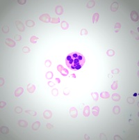 Hypersegmented Neutrophil