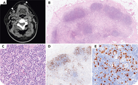 ALK-positive anaplastic large cell lymphoma, Hodgkin-like pattern with unexplained fever