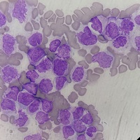 Acute promyelocytic leukemia hypogranular variant