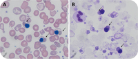 A rare glimpse of Fessas bodies in a patient with β-thalassemia major postsplenectomy