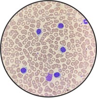 Hairy Cell Leukemia.1