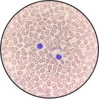 Hairy Cell Leukemia.2