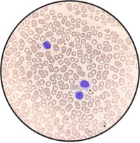 Hairy Cell Leukemia.3