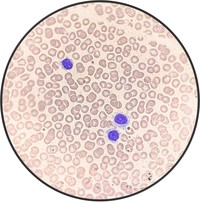 Hairy Cell Leukemia.3