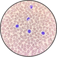 Hairy Cell Leukemia.4