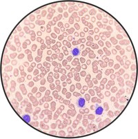 Hairy Cell Leukemia.5