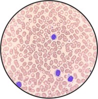 Hairy Cell Leukemia.5