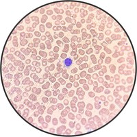 Hairy Cell Leukemia.6